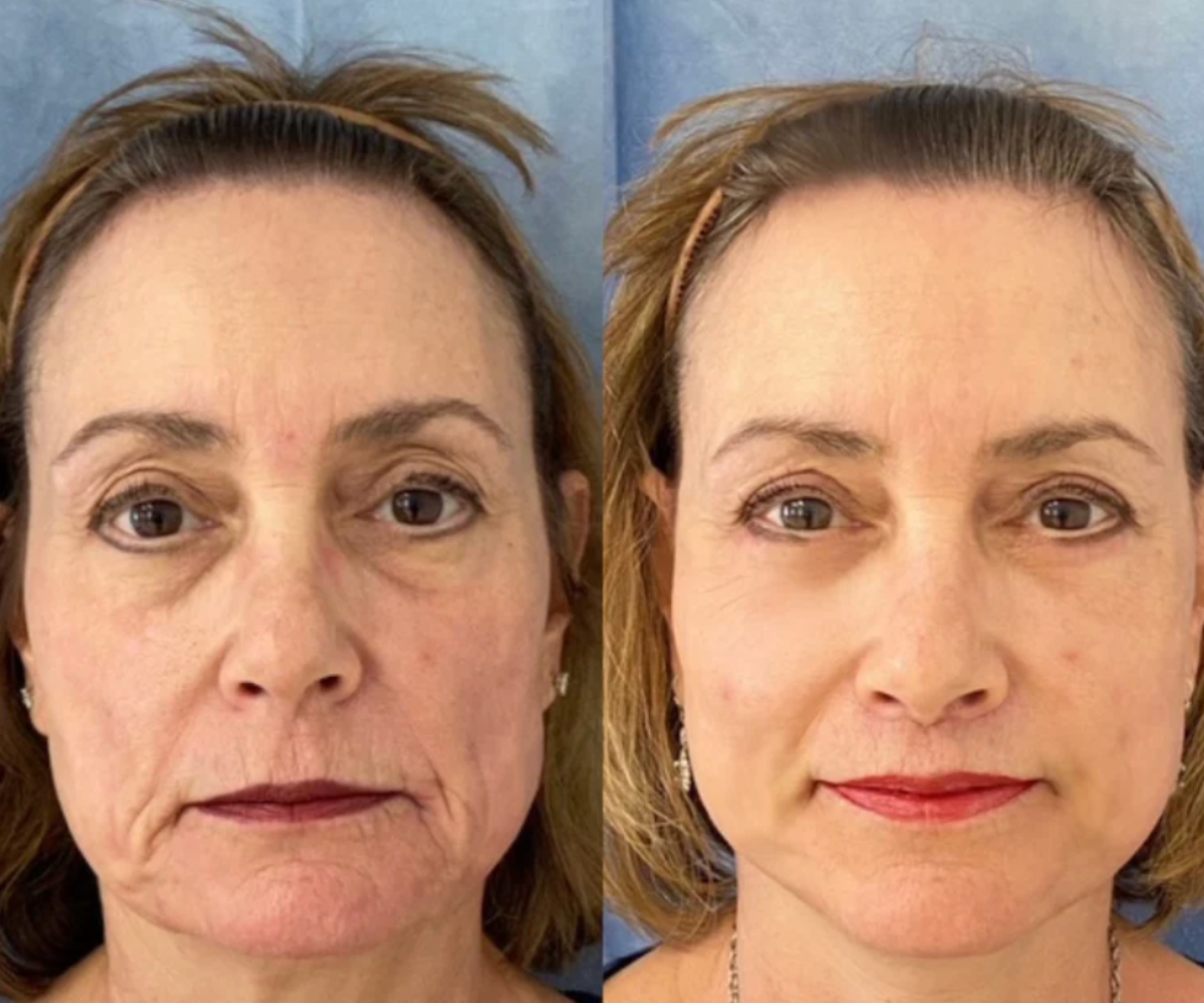 The Visible Lifting Set | Dandona